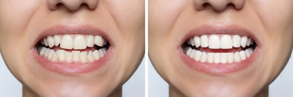 Smile before and after orthodontic teeth straightening – overbite treatment options